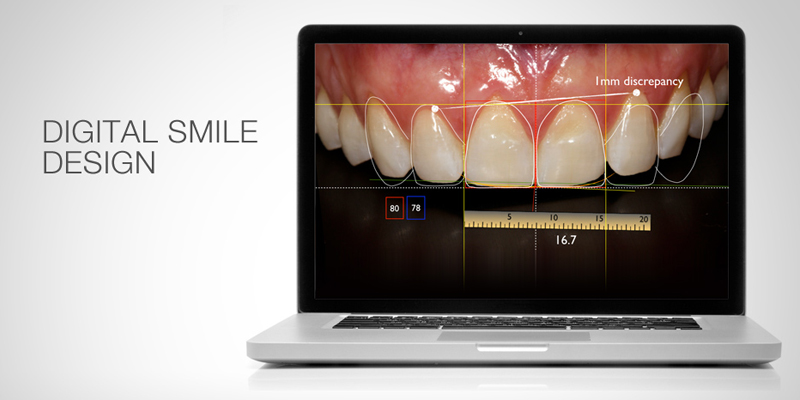 Digital Smile Design used at PERFECT SMILE Dental Clinic